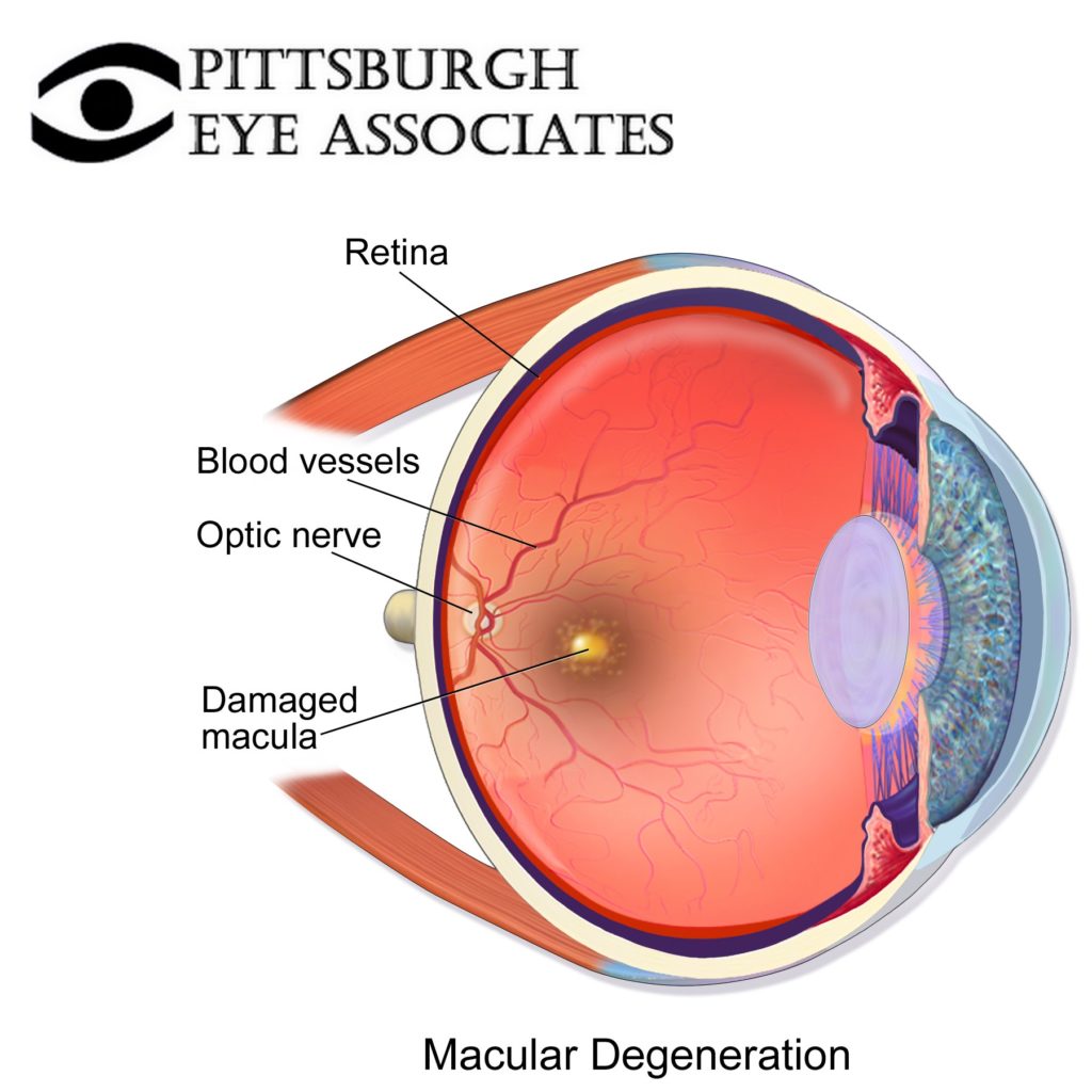 macular-degeneration-pittsburgh-eye-associates